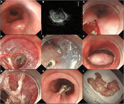 Risk stratification in patients with upper gastrointestinal submucosal tumors undergoing submucosal tunnel endoscopic resection